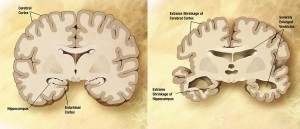 Bei der Alzheimer-Krankheit erkrankt das Gehirn. Die Nervenzellen im Gehirn gehen zugrunde.
