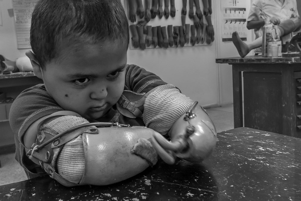 Kind in Werkstatt trägt Armprothesen.